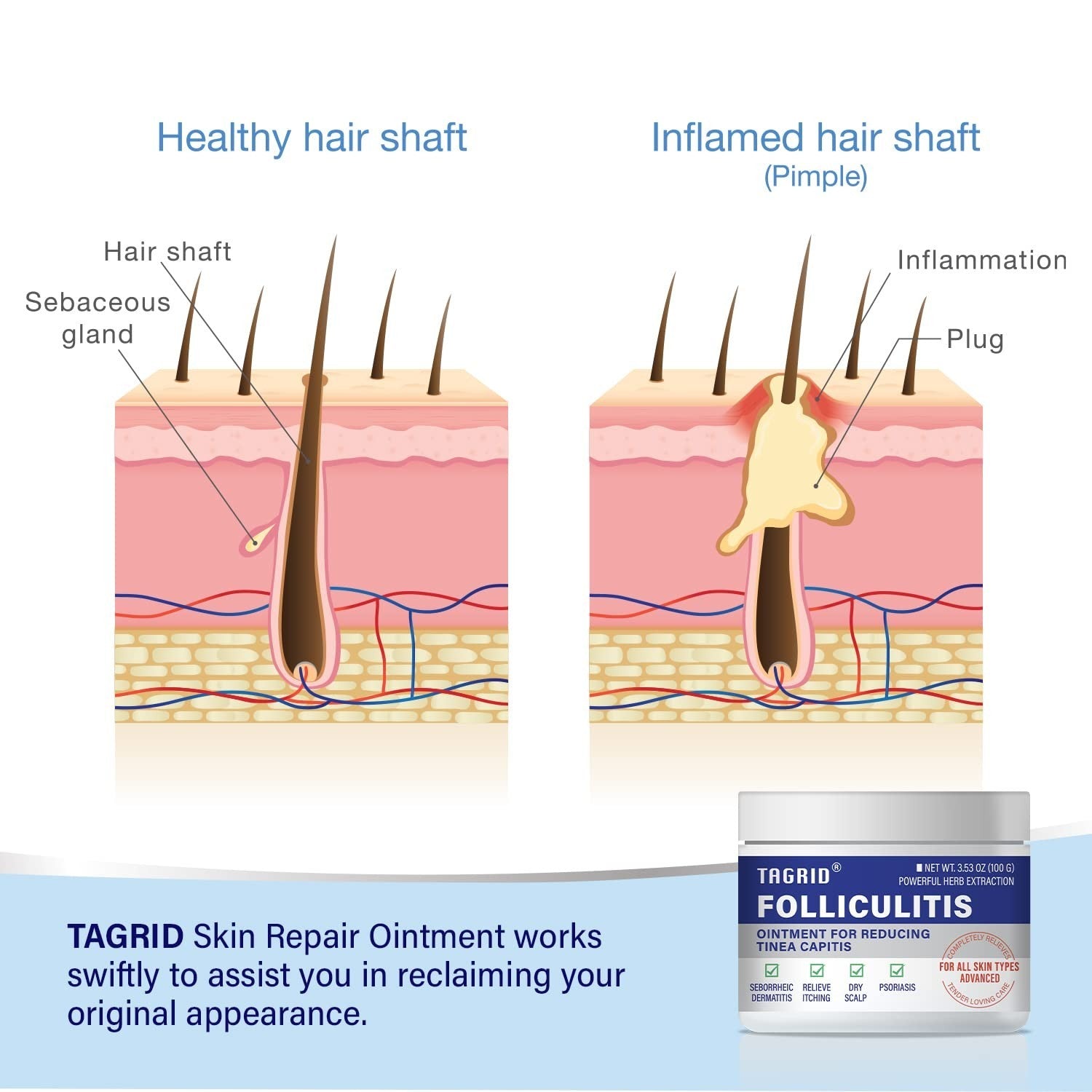 TAGRID Folliculitis