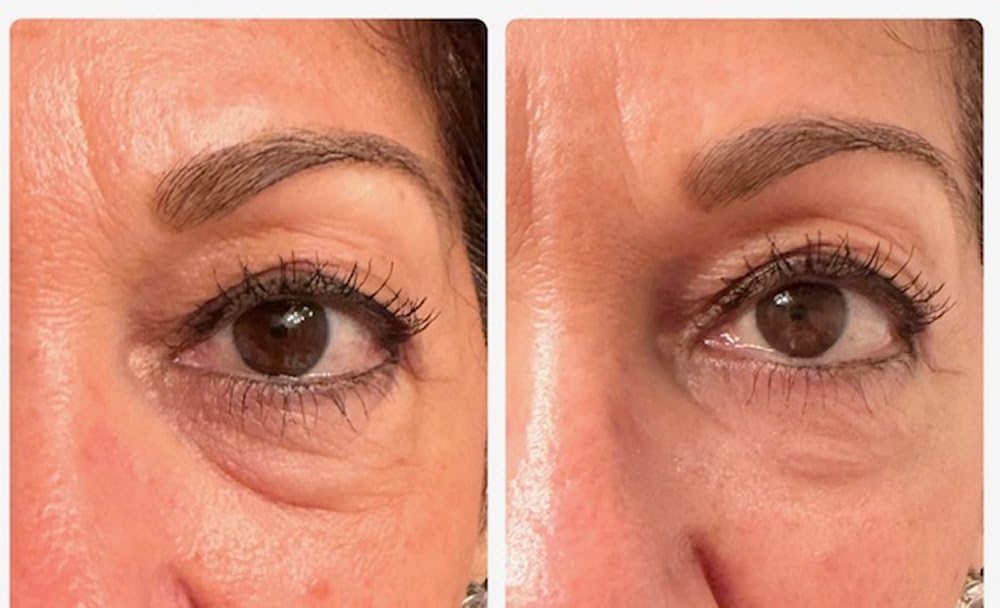 Instant Eye Bag Puffiness And Wrinkle Remover Cream For Women And Men Made In The USA! Cruelty-Free Larger Size