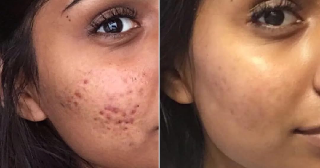 Acne Cream Scar Treatment Fast Acting - 24-Hour Spot Reduction, Anti Acne Formula, Sensitive Skin Safe, Includes Rapid Acne Scar Removal, Moisturiser, Deep Pore Cleansing - 15g