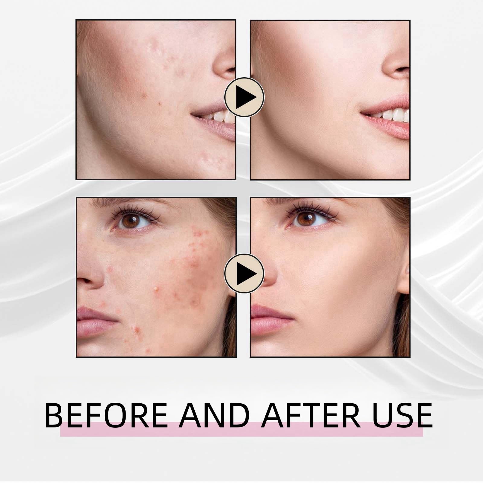 Azelaic Acid 15% Acne Tratment Gel,Azelaic Acid Serum Cream with Niacinamide & Vitamin C,Anti Acne Gel for Spot Prone Skin,Face Serum for Women,Hydrating Serum,Moisturiser Face,Serums Skincare