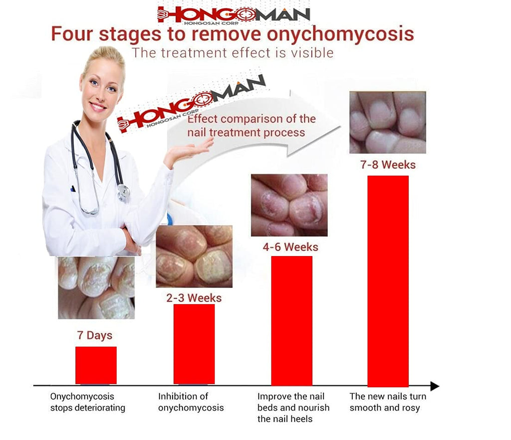 Hongosan Nail Toenail el original