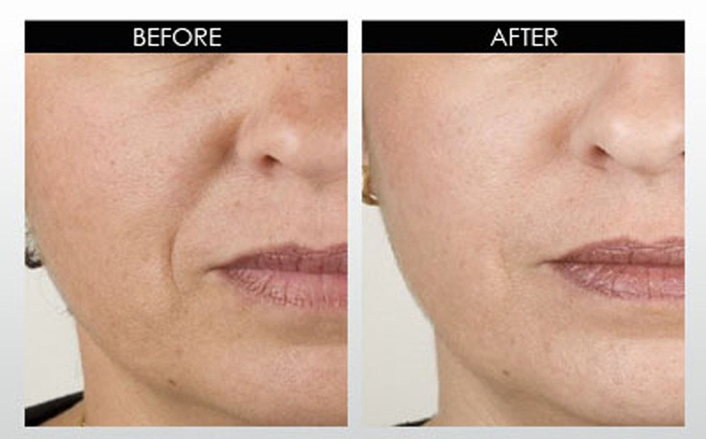 DNA Code®- No Needle Alternative-Argireline NeuroPeptides Wrinkle Reduce Moisturizer+Matrixyl 3000, Syn-Ake, SNAP-8, Copper Peptides