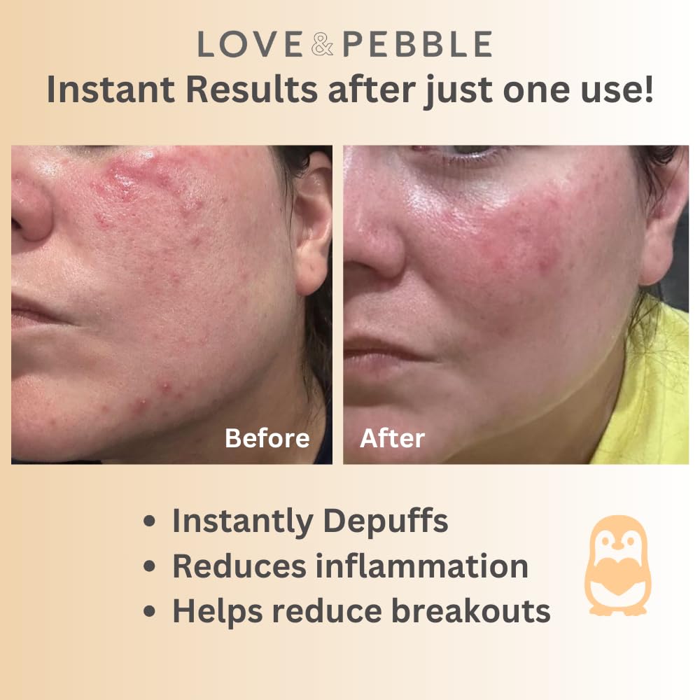 Love & Pebble Beauty Pops - Ice Roller Massage & Skin Care Ice Mask for Face Set with Turmeric & Aloe | Cryo Dermal Benefits of Ice Face Roller and Gua Sha, As Seen on Shark Tank and Tik Tok