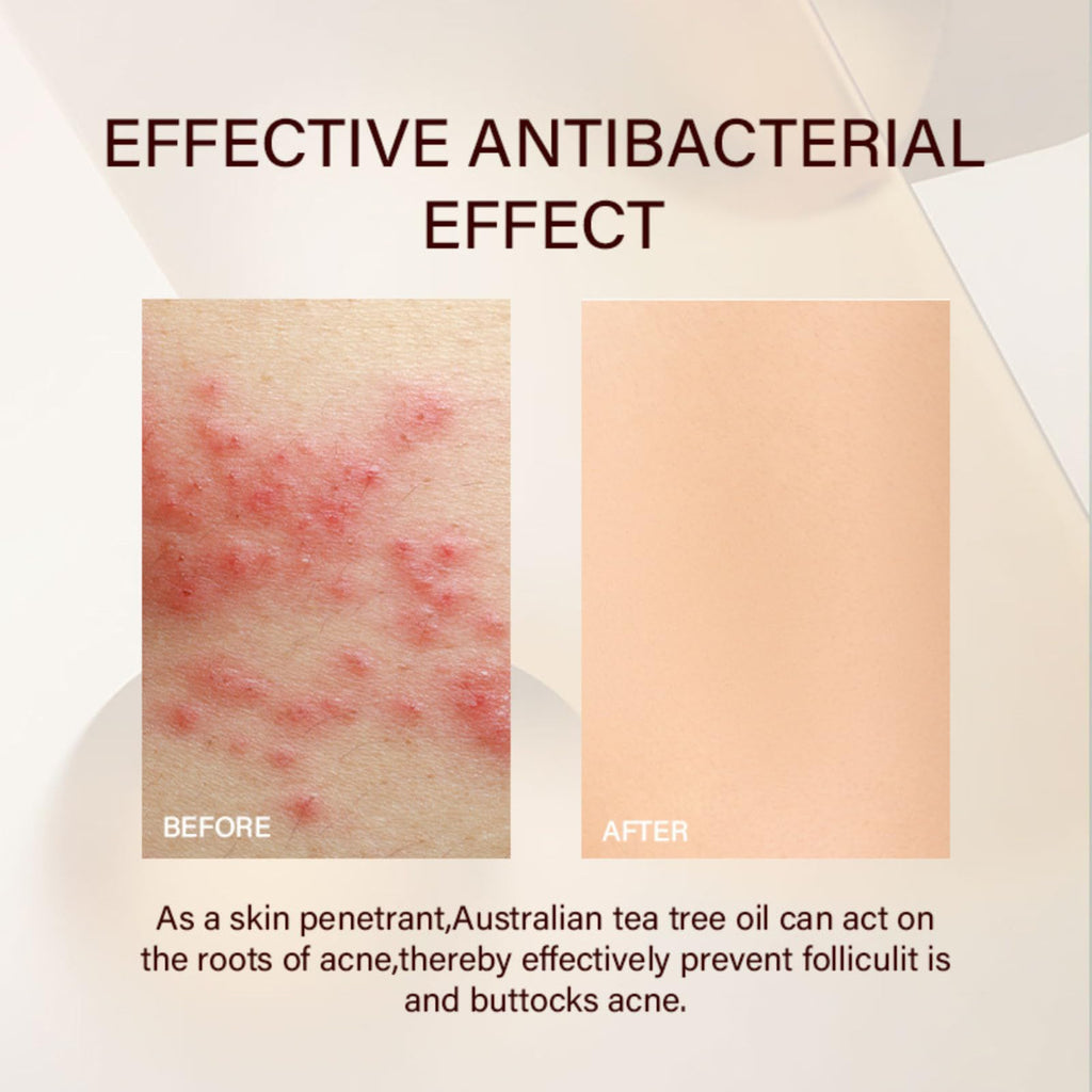 Butt Acne Cream for Women, Butt Acne Clearing with Tea Tree Oil, Body Acne Lotion for Back, Body Moisturiser for Booty Breakouts & Spot, Pimple Cream for Sensitive Skin, Delicate & Smooth