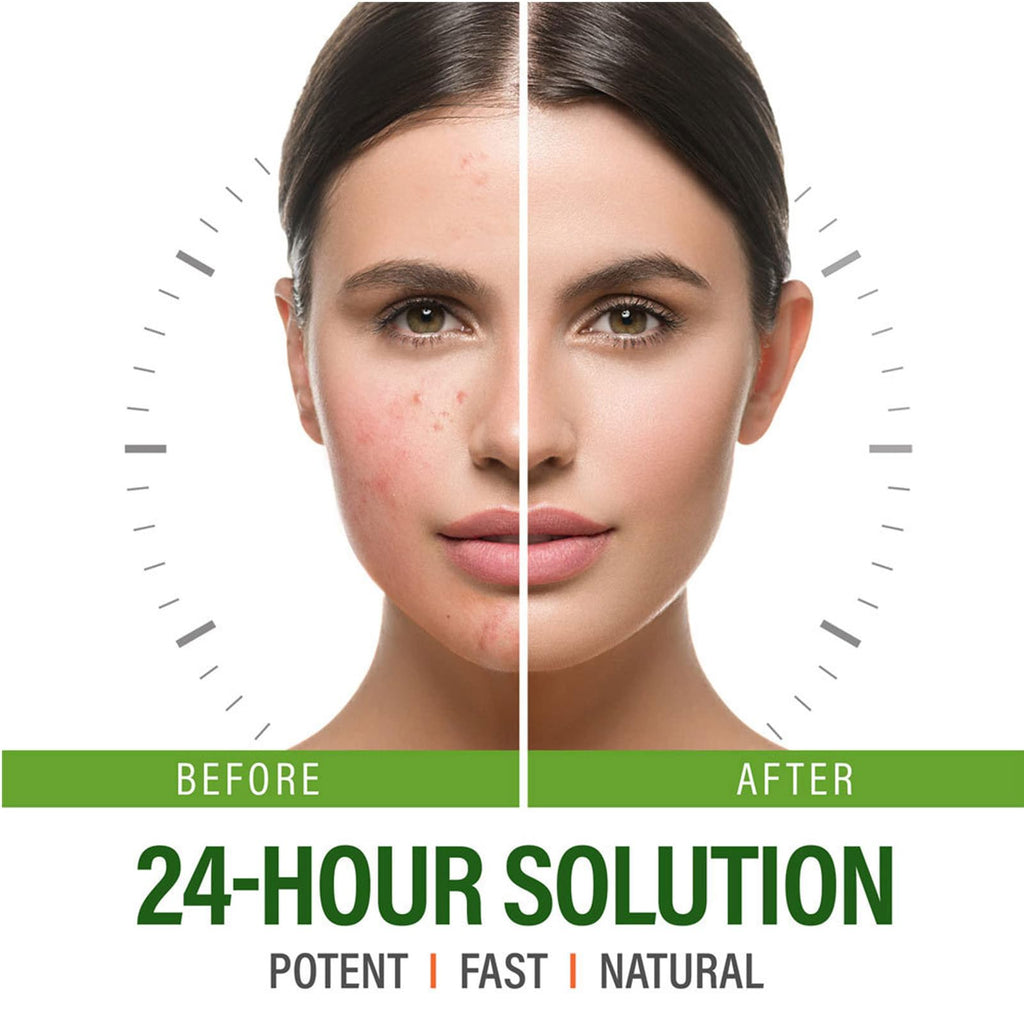 Herbal Acne Removing Cream,Professionally Remove Acne Marks,Gently Moisturize,Refreshing & Not Greasy,Improving Sensitive Skin Prone to Acne,Acne Scar Cream & Pimple Remover For All Skin Types