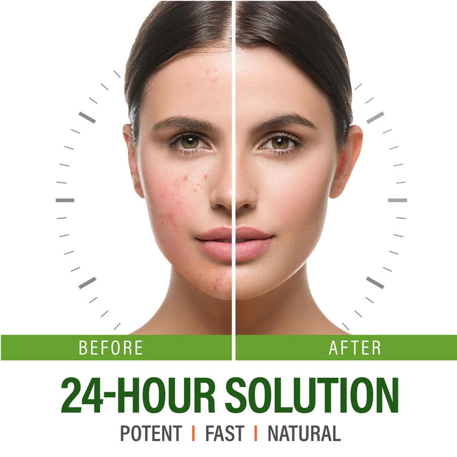 Herbal Acne Removing Cream,Professionally Remove Acne Marks,Gently Moisturize,Refreshing & Not Greasy,Improving Sensitive Skin Prone to Acne,Acne Scar Cream & Pimple Remover For All Skin Types