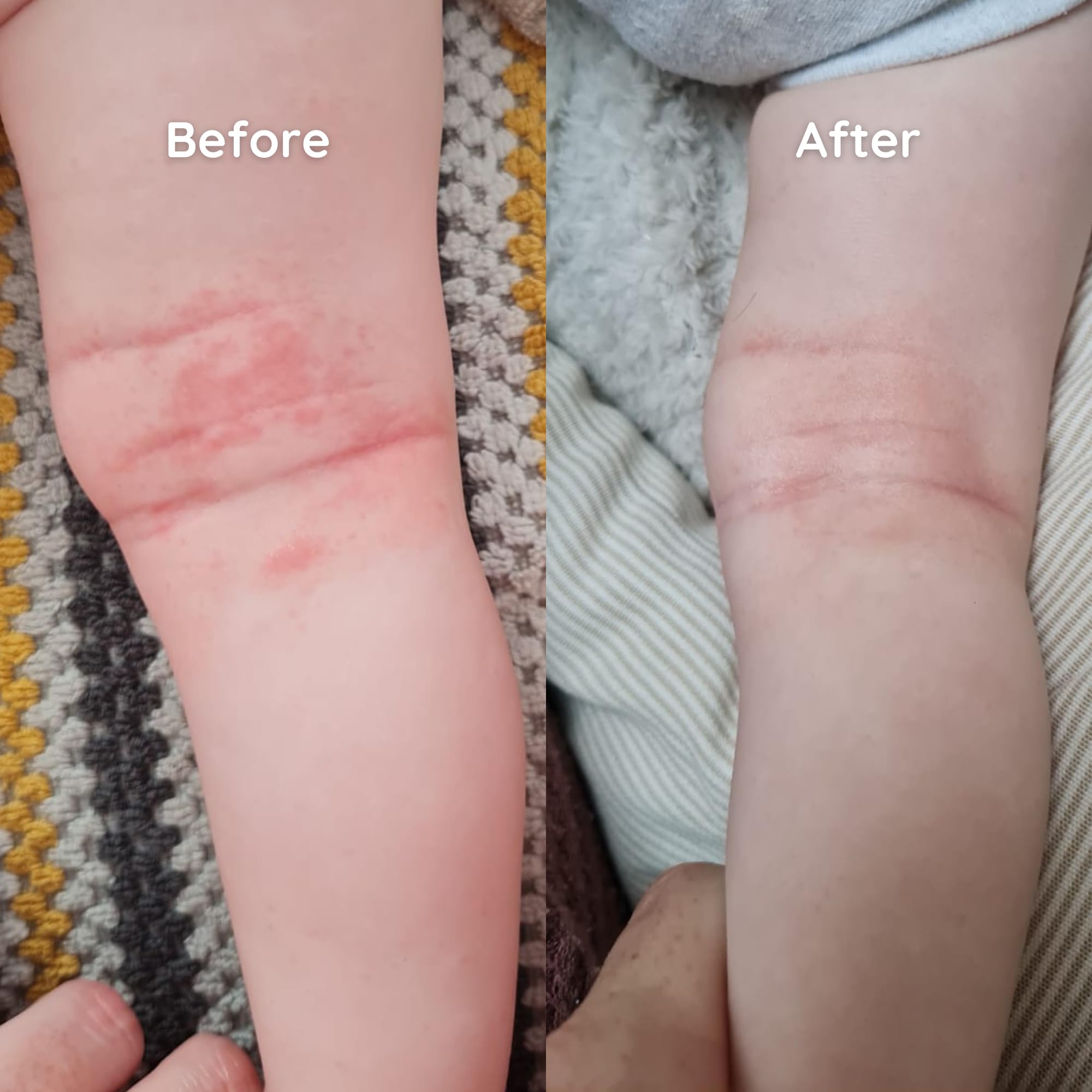 Salcura Natural Skin Therapy, Bioskin Junior Outbreak Rescue Cream, Packed With Natural Ingredients, Soothes Irritation, Nourish & Sooth Dryness & Flakiness, Supports The Skin Back To Health 50ml