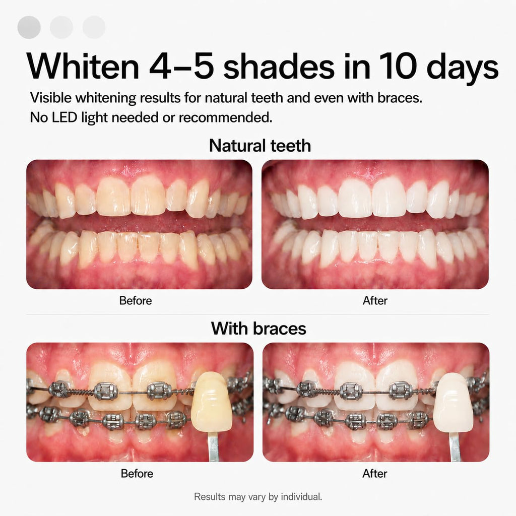 Opalescence Go 15- Prefilled Teeth Whitening Trays Kit - 15% Hydrogen Peroxide - (10 Treatments) Dentist Recomended - Made by Ultradent Products. Teeth Whitening Kit -Mint - 5194-1
