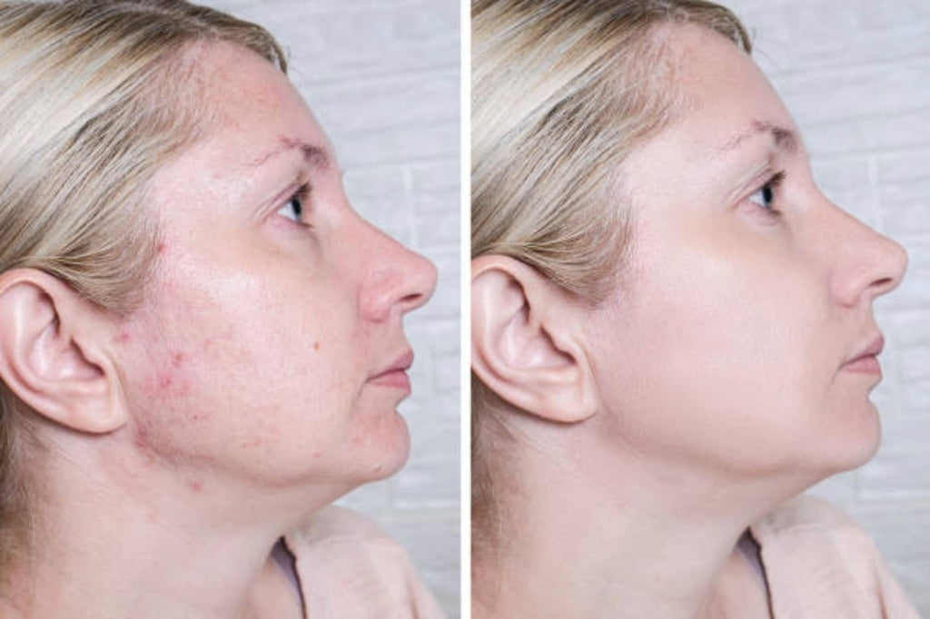 Acne Cream Scar Treatment Fast Acting - 24-Hour Spot Reduction, Anti Acne Formula, Sensitive Skin Safe, Includes Rapid Acne Scar Removal, Moisturiser, Deep Pore Cleansing - 15g