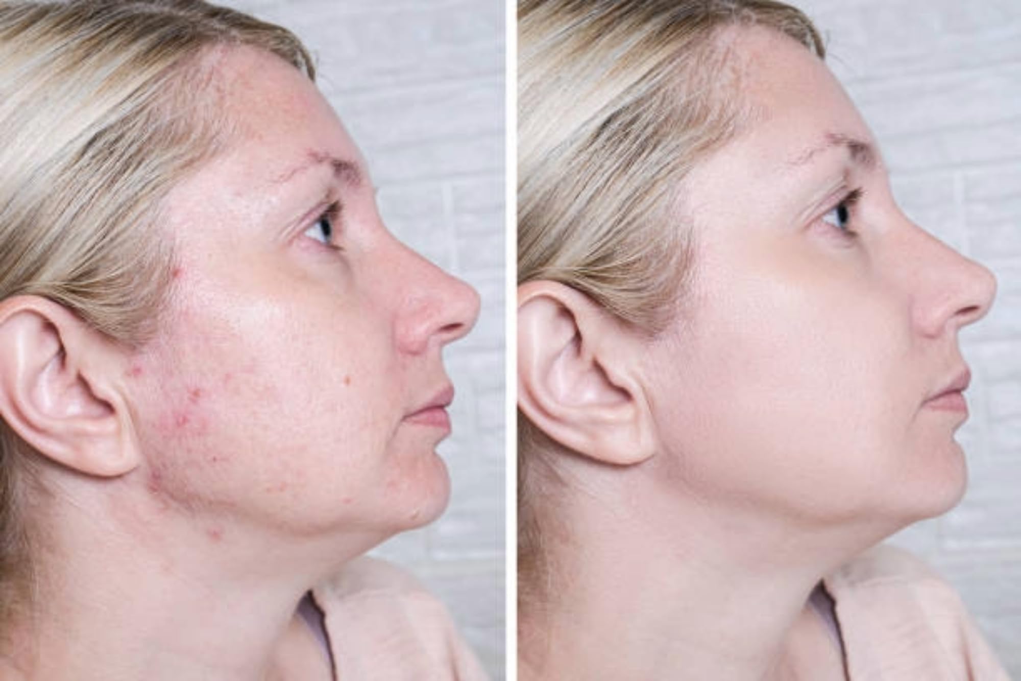 Acne Cream Scar Treatment Fast Acting - 24-Hour Spot Reduction, Anti Acne Formula, Sensitive Skin Safe, Includes Rapid Acne Scar Removal, Moisturiser, Deep Pore Cleansing - 15g