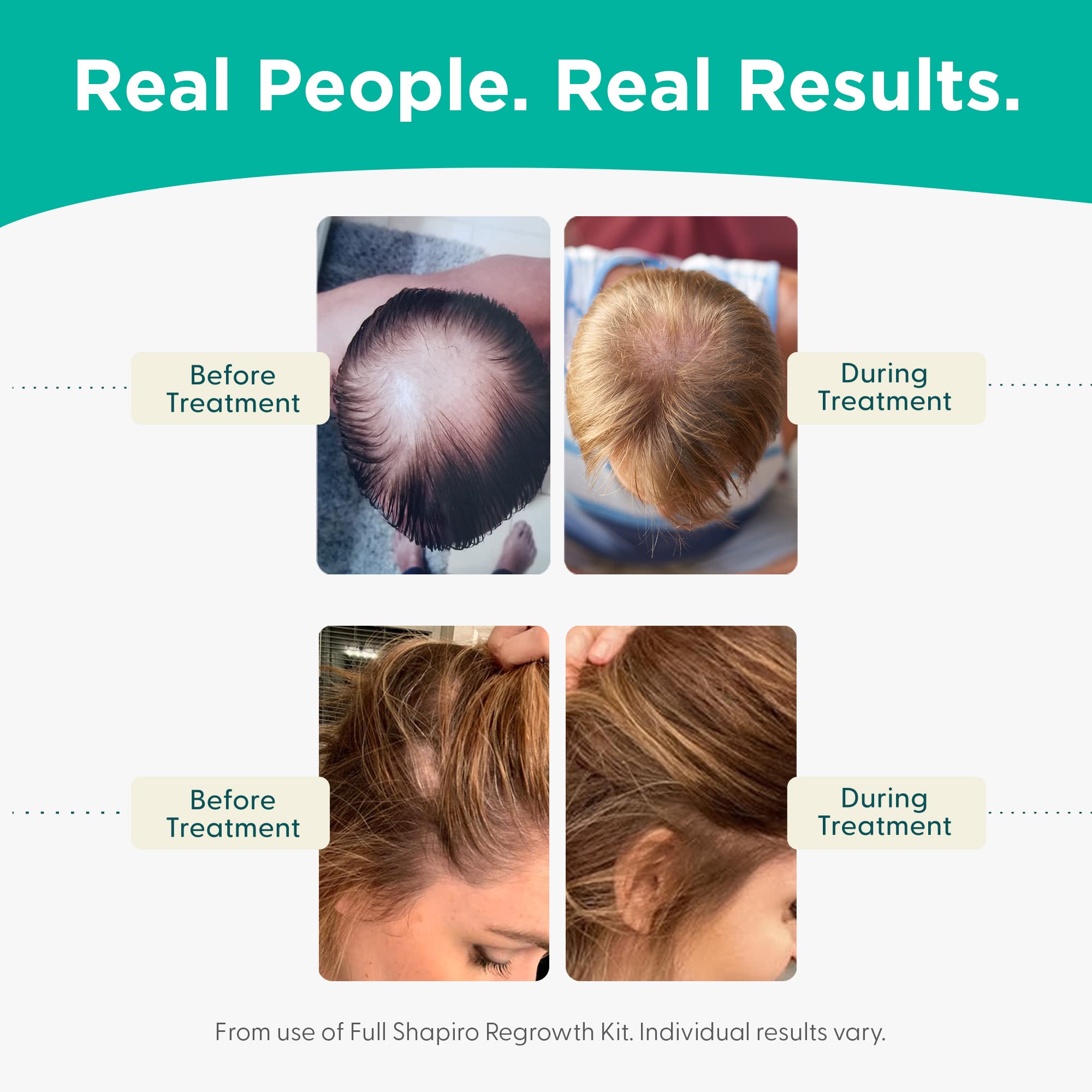 Shapiro MD Hair Growth Experts Vegan Hair Loss Shampoo for Thinning Hair | Experience Healthier, Fuller and Thicker Looking Hair (1 Month Supply)