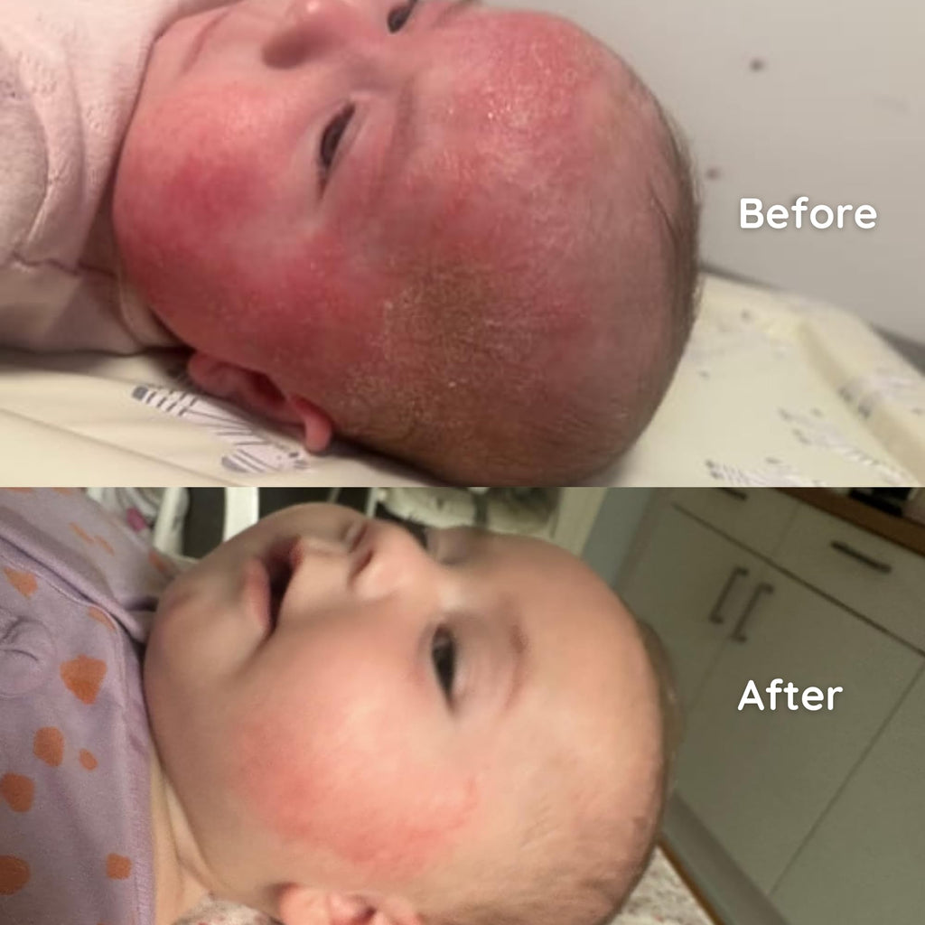 Salcura Natural Skin Therapy, Bioskin Junior Outbreak Rescue Cream, Packed With Natural Ingredients, Soothes Irritation, Nourish & Sooth Dryness & Flakiness, Supports The Skin Back To Health 50ml