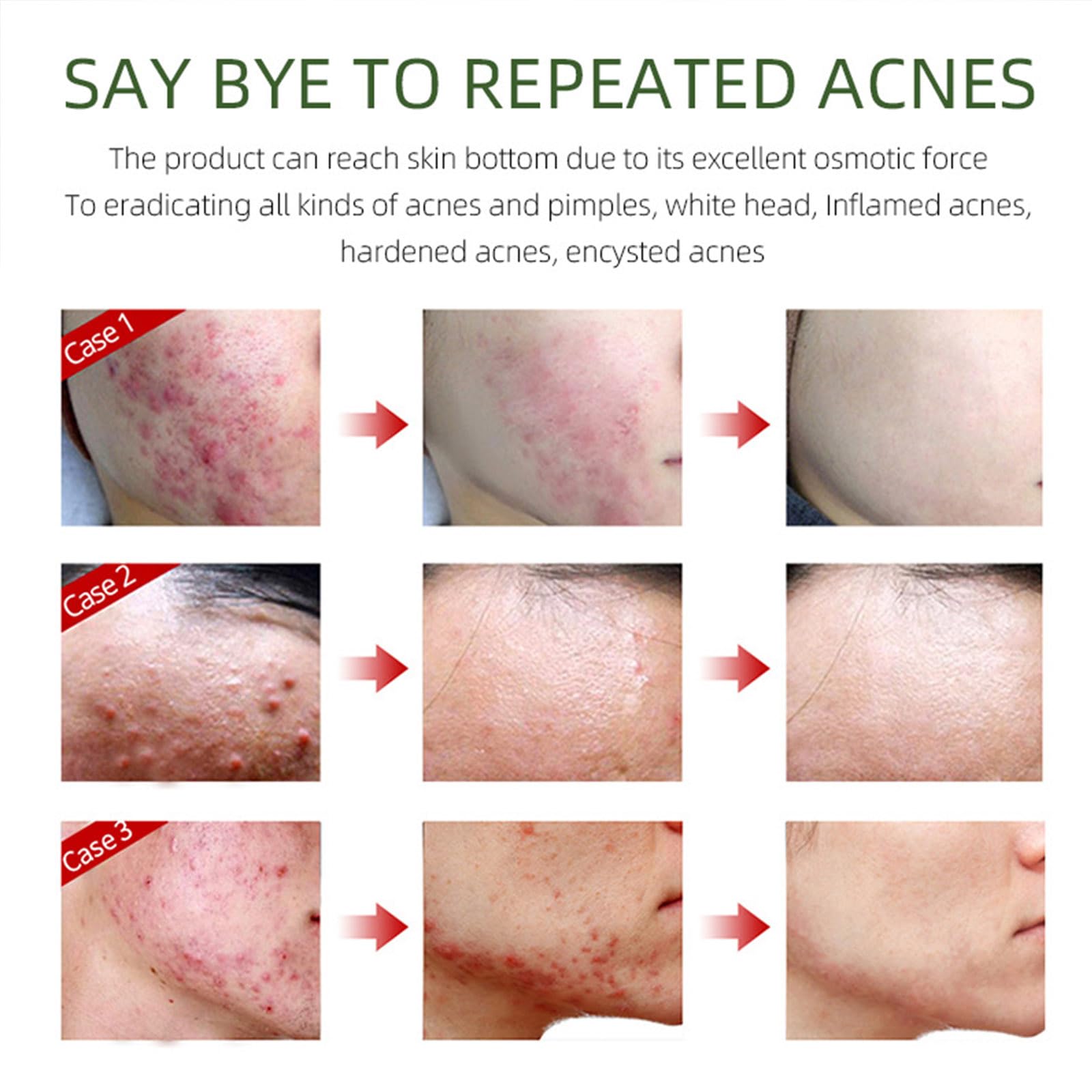 Herbal Acne Removing Cream,Professionally Remove Acne Marks,Gently Moisturize,Refreshing & Not Greasy,Improving Sensitive Skin Prone to Acne,Acne Scar Cream & Pimple Remover For All Skin Types