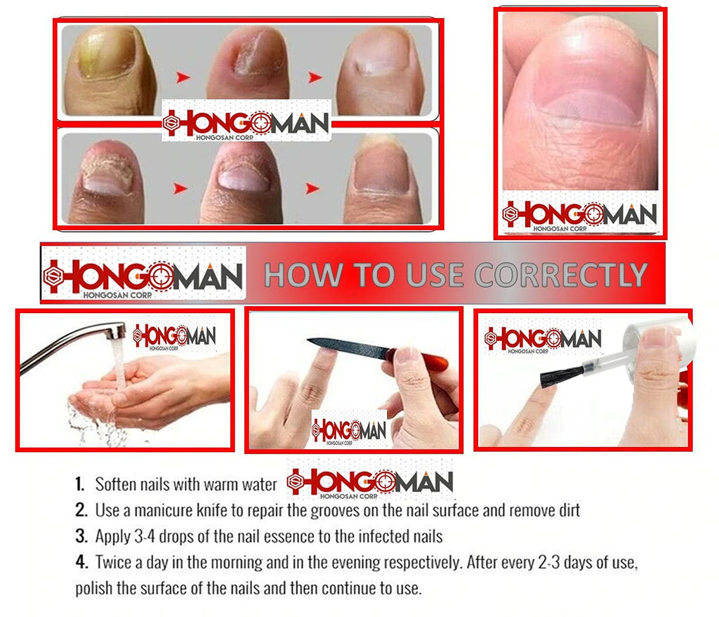 Hongosan NAIL and Skin toenail Athlete's Foot Treatment Rash Athletes Foot Skin and Nails HONGOS Nail Solution