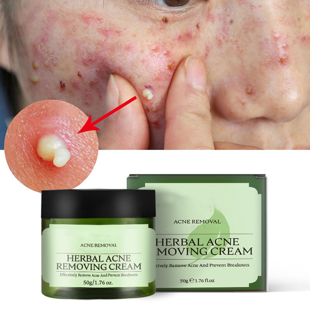 Herbal Acne Removing Cream,Professionally Remove Acne Marks,Gently Moisturize,Refreshing & Not Greasy,Improving Sensitive Skin Prone to Acne,Acne Scar Cream & Pimple Remover For All Skin Types