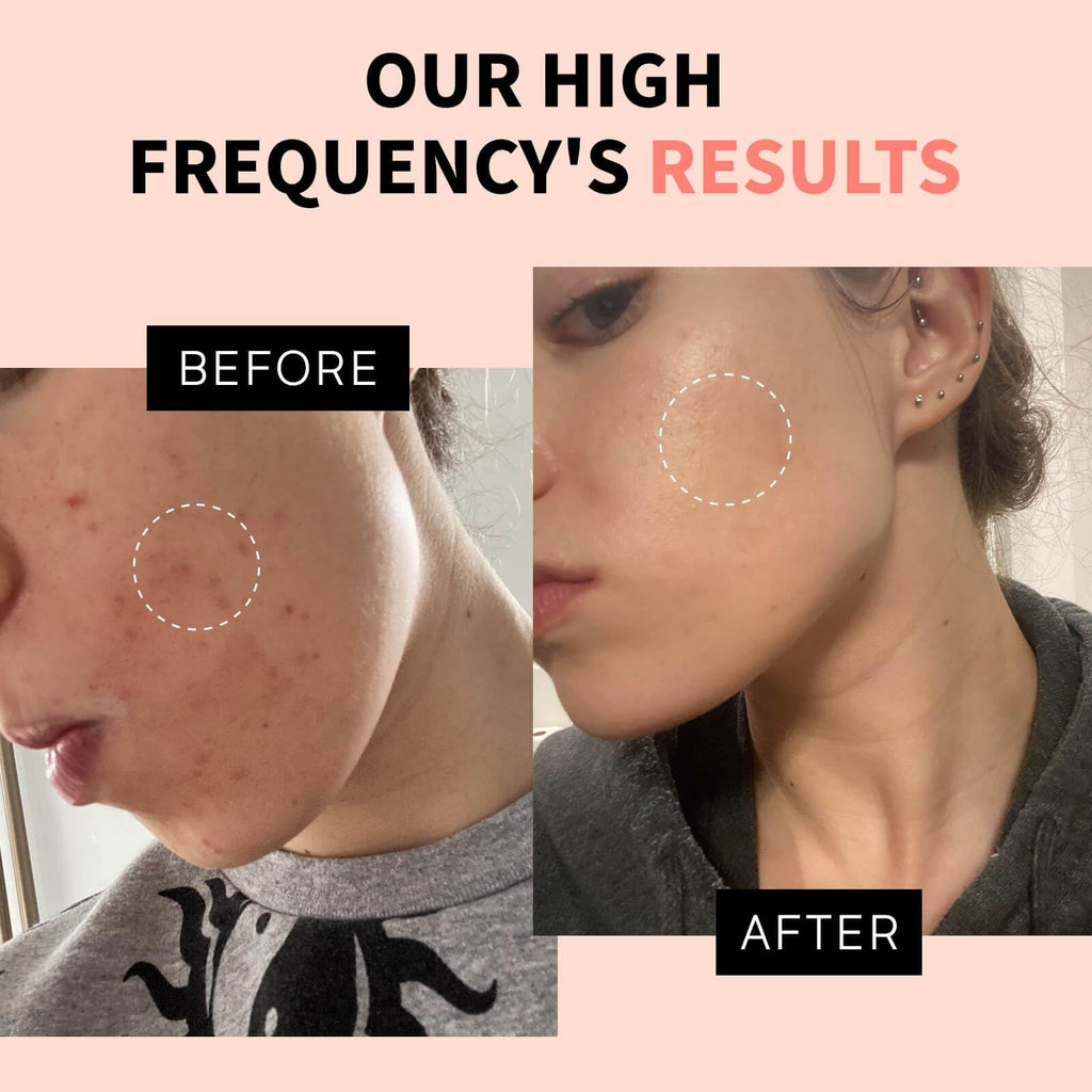 Lucsuer OxyGlow2 Cordless High Frequency Facial Machine - ProFacial Wand Clinical Skin Therapy Wand - Neon+Argon Gas (Onyx Black)