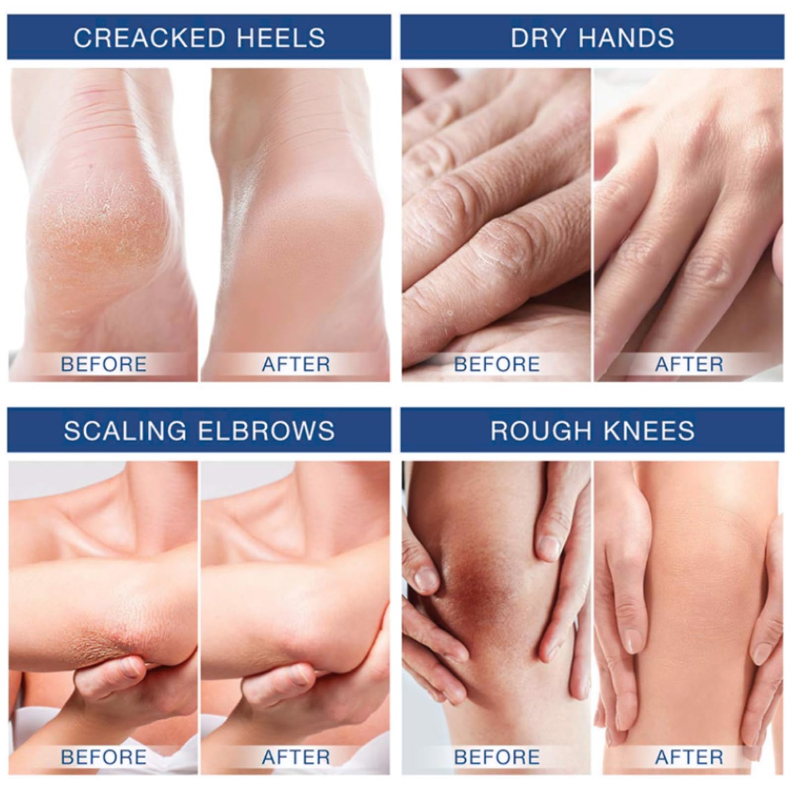 100ml 60% Urea Cream - Cracked Heel Repair Cream For Feet and Hand - Foot Cream for Cracked Heels and Dry Skin - Urea Creams 60 Percent for Feet