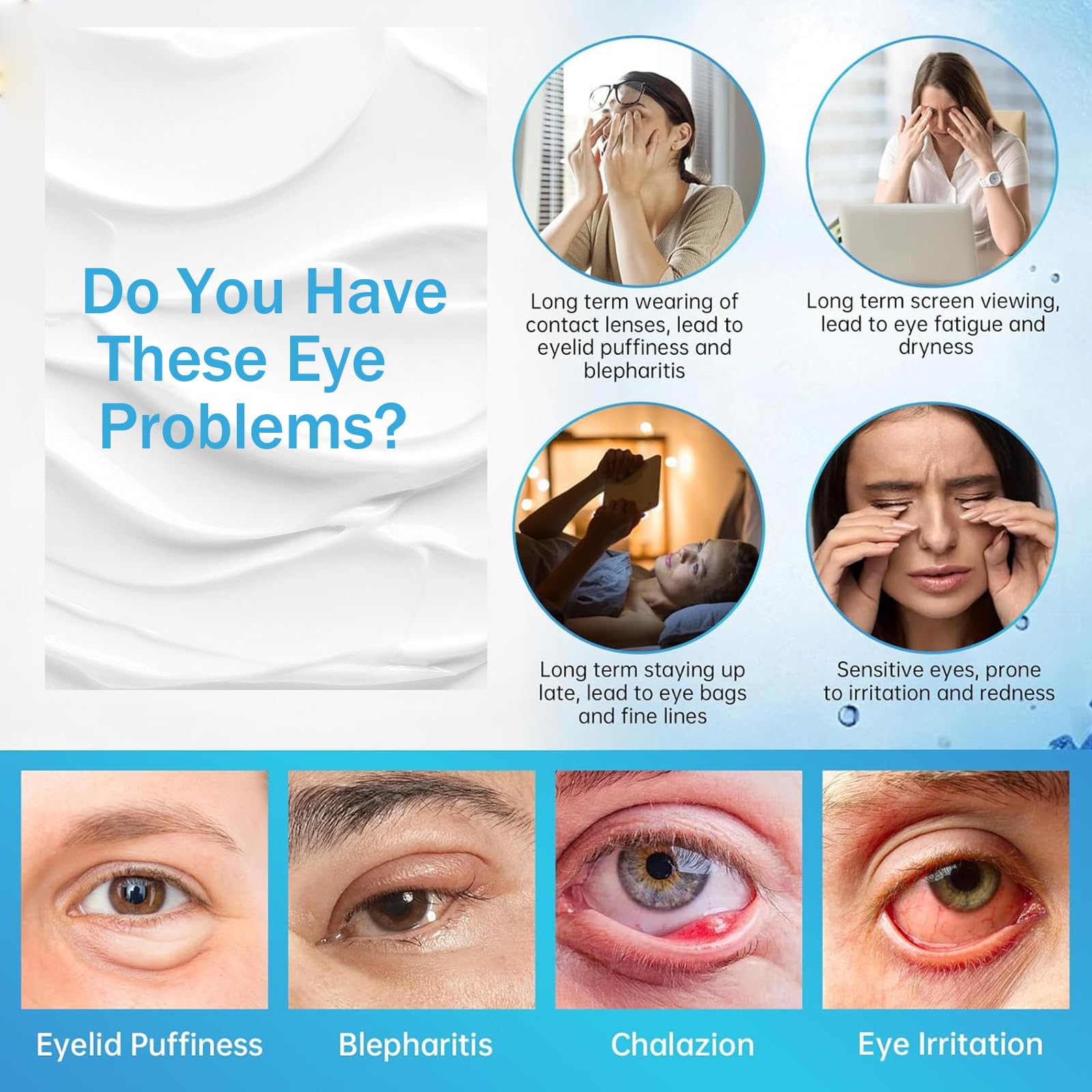 2PCS Chalazion & Blepharitis Treatment Eye Cream, Chalazion Eye Treatment, Eyelid Cream for Blepharitis, Stye Treatment for Dry Eyes, Moisturizing Eyelid Cream for Daily Eye Care, Soothe, Hydrate