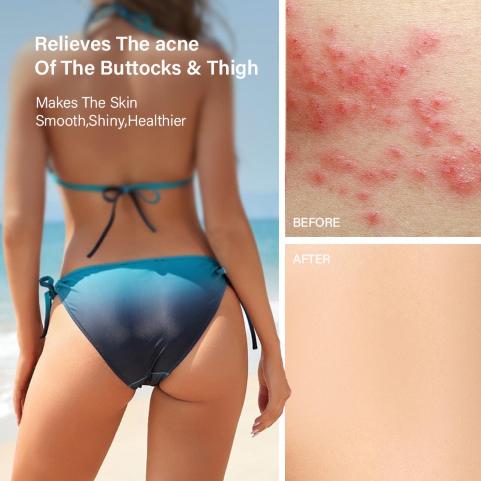 Butt Acne Cream for Women, Butt Acne Clearing with Tea Tree Oil, Body Acne Lotion for Back, Body Moisturiser for Booty Breakouts & Spot, Pimple Cream for Sensitive Skin, Delicate & Smooth