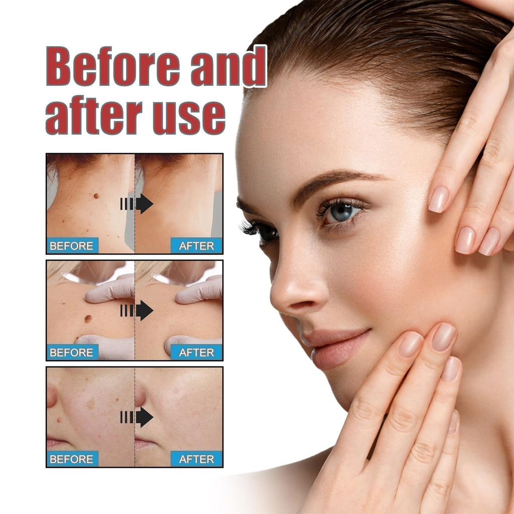 288PCS T-ag'gone Patch,Spot Stickers,Nano Patch for Face and Skin,Face Care P/atch,Acne Pimple Patches,Skin T-ag Remover Patches,M-ole Remover,Skin Ta-g P/atches,Skin Ta-g R/emover,W-art Treatment