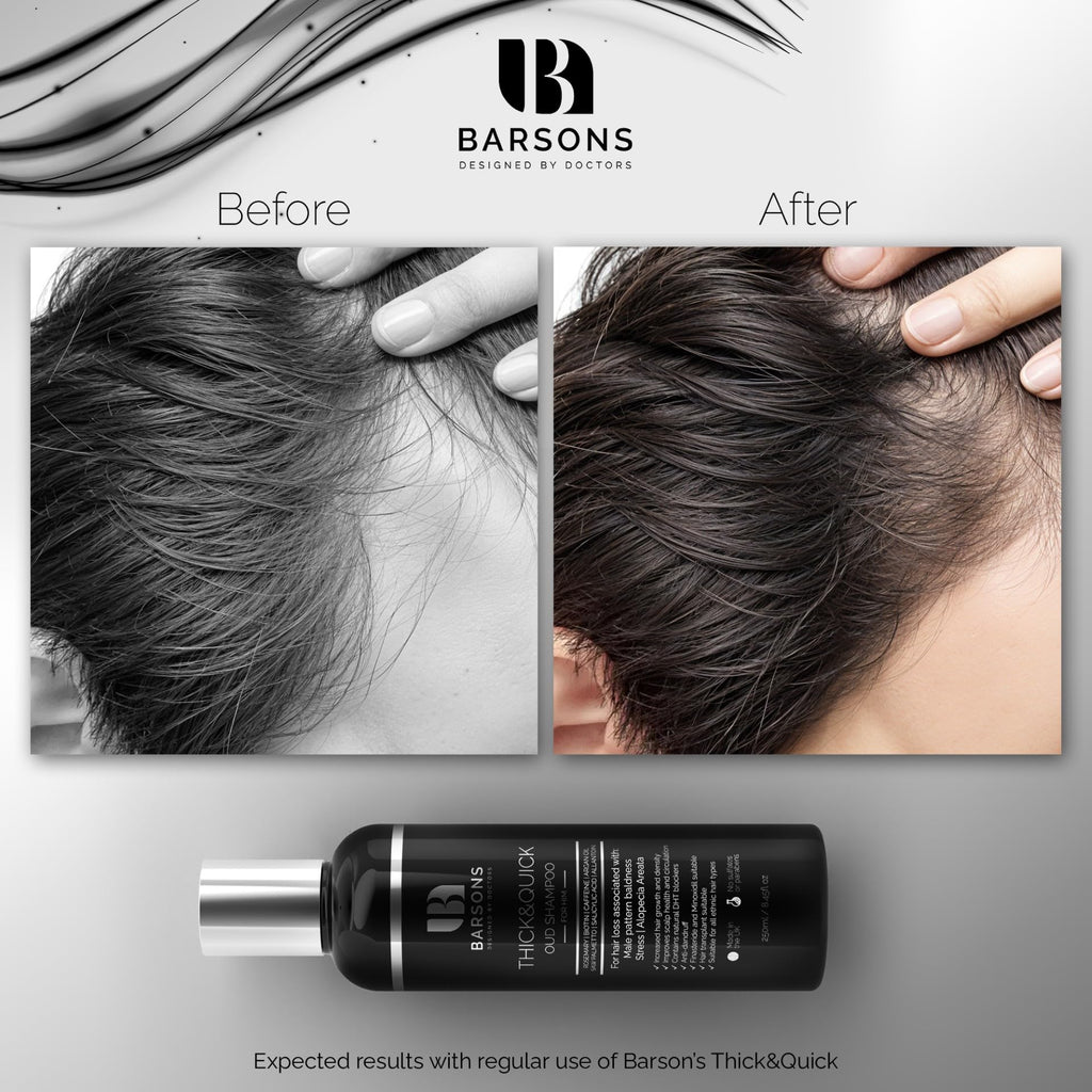 BARSONS THICK&QUICK Oud Shampoo for Men with Thinning Hair – Doctor-Formulated Hair Thickening Treatment – DHT Blocker – Hair Transplant Friendly – Rosemary, Biotin, Argan Oil, Caffeine – Sulfate-Free