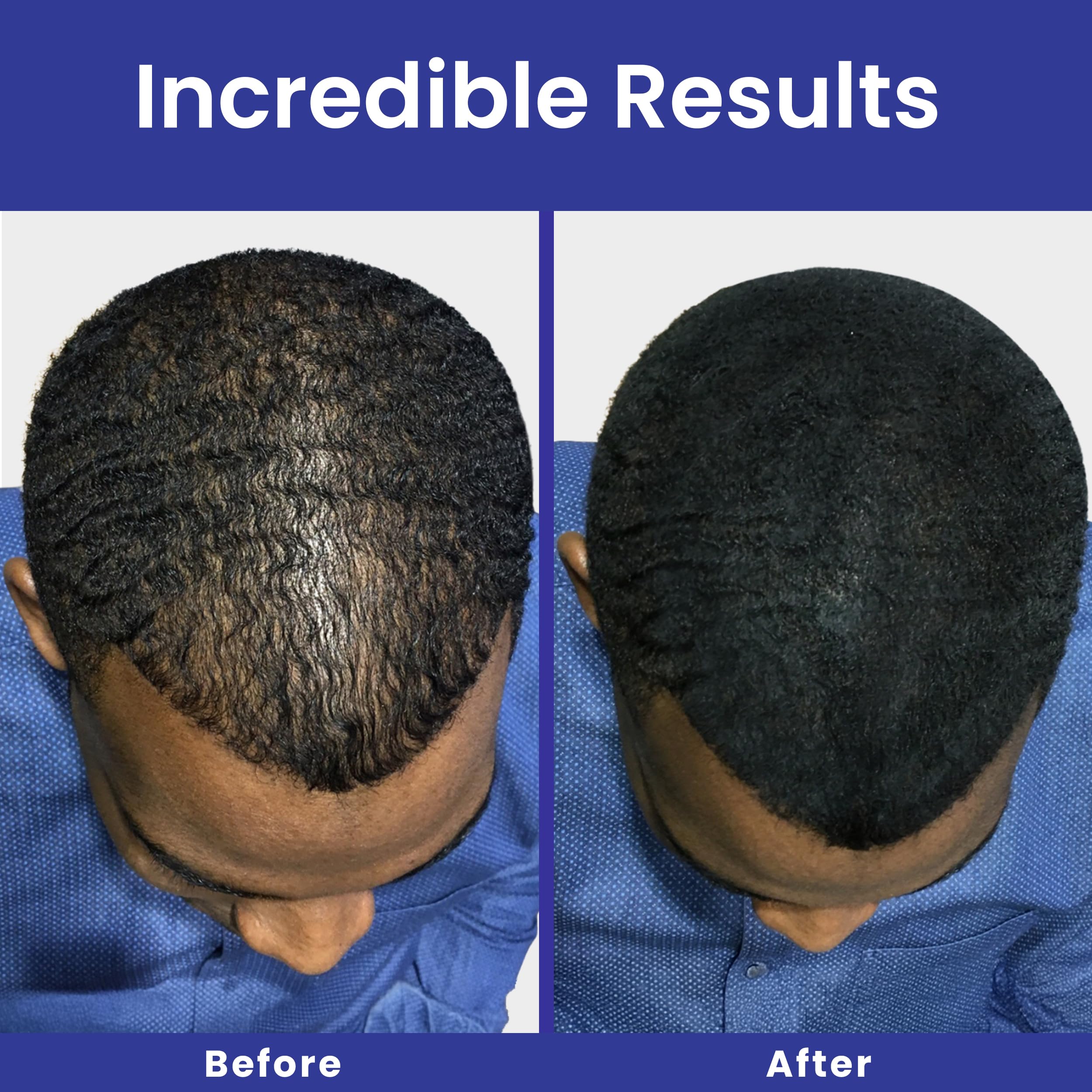INFINITY Hair Fibers Dark Brown for Thinning Hair for Women & Men - 100% Undetectable Hair Building Fiber Powder - Conceal Hair Loss in 15 Seconds, 60g